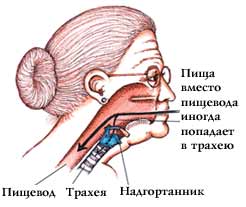 Застревает еда. Попадание пищи в трахею. Пища в дыхательном горле. Попало в дыхательное горло. Как пища попадает в трахею.